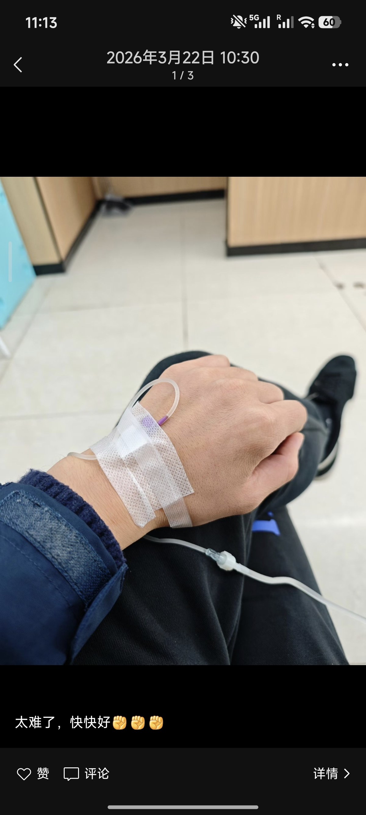 手背输液